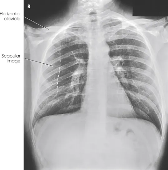 Radiografia de tórax AP com as clavículas horizontais e a imagem da escápula sobre o pulmão direito indicadas