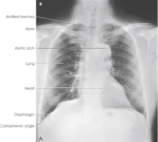 Radiografia de tórax PA com traqueia, ápice, arco aórtico, pulmão, coração, diafragma e seio costofrênico indicados