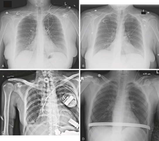 Quatro radiografias de tórax AP feitas no leito: angulação errada com aspecto lordótico, repetição correta, paciente com vários dispositivos e paciente pós-operatório