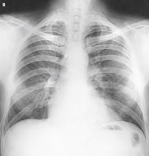 Radiografia de tórax PA em pé, para comparar com a AP: clavículas oblíquas e coração menor