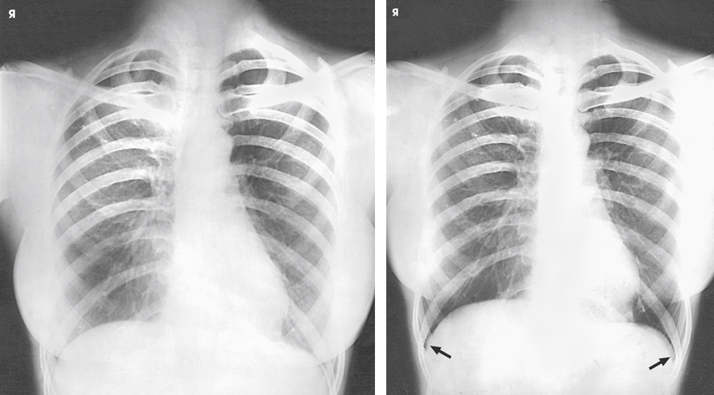 Duas radiografias PA da mesma paciente: à esquerda, as mamas cobrem as bases dos pulmões; à direita, com as mamas afastadas, os seios costofrênicos aparecem
