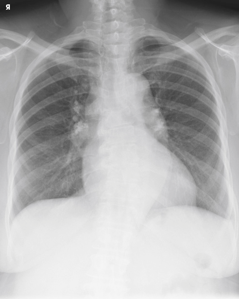 Radiografia de tórax PA sem rotação, com a traqueia na linha média e os pulmões inteiros dos ápices aos seios costofrênicos
